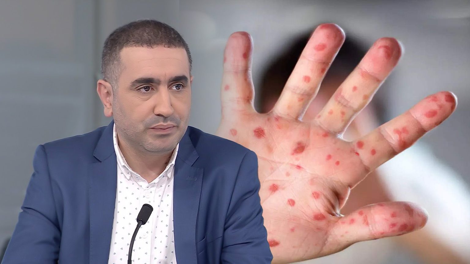 جدري القردة.. المرابط يكشف لـ”سفيركم” صحة ظهور حالة بإسبانيا قادمة من المغرب
